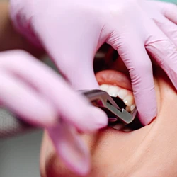 Extractions & Preservation